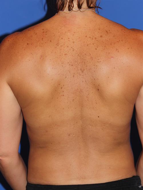 Breast Augmentation After Photo | Phoenix and Scottsdale, AZ | Scottsdale Center for Plastic Surgery