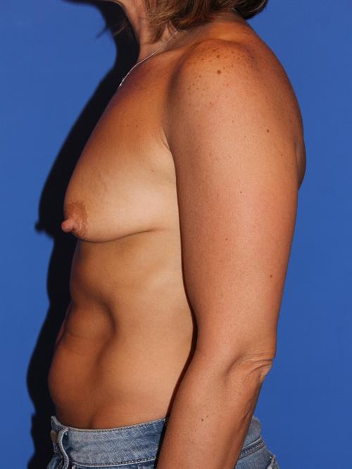 Breast Augmentation Before Photo | Phoenix and Scottsdale, AZ | Scottsdale Center for Plastic Surgery