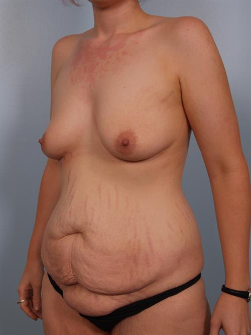 Tummy Tuck Before Photo | Phoenix and Scottsdale, AZ | Scottsdale Center for Plastic Surgery