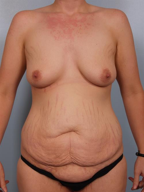 Breast Augmentation Before Photo | Paradise Valley, AZ | Scottsdale Center for Plastic Surgery