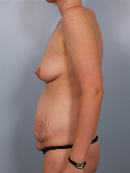 Tummy Tuck Before Photo | Phoenix and Scottsdale, AZ | Scottsdale Center for Plastic Surgery