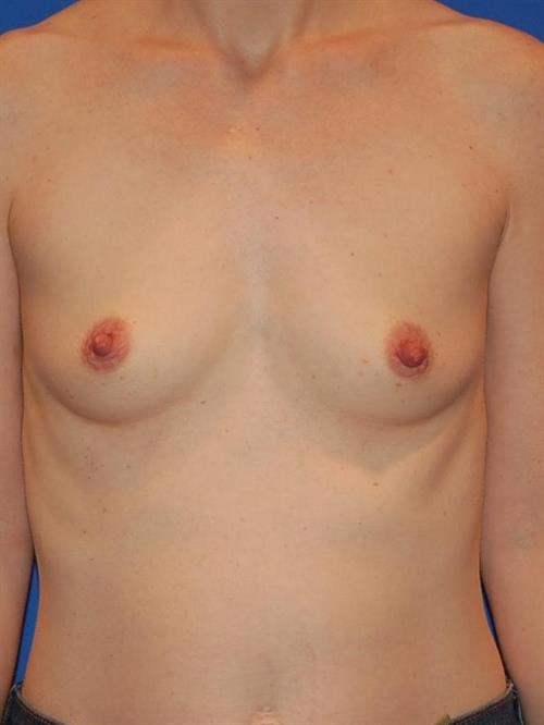 Breast Augmentation Before Photo | Phoenix and Scottsdale, AZ | Scottsdale Center for Plastic Surgery