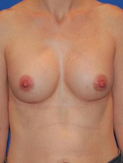 Breast Augmentation After Photo | Phoenix and Scottsdale, AZ | Scottsdale Center for Plastic Surgery