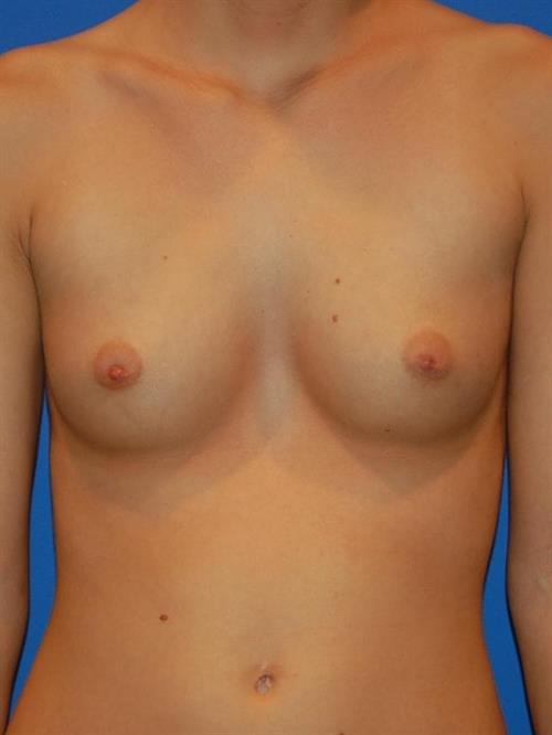 Breast Augmentation Before Photo | Phoenix and Scottsdale, AZ | Scottsdale Center for Plastic Surgery