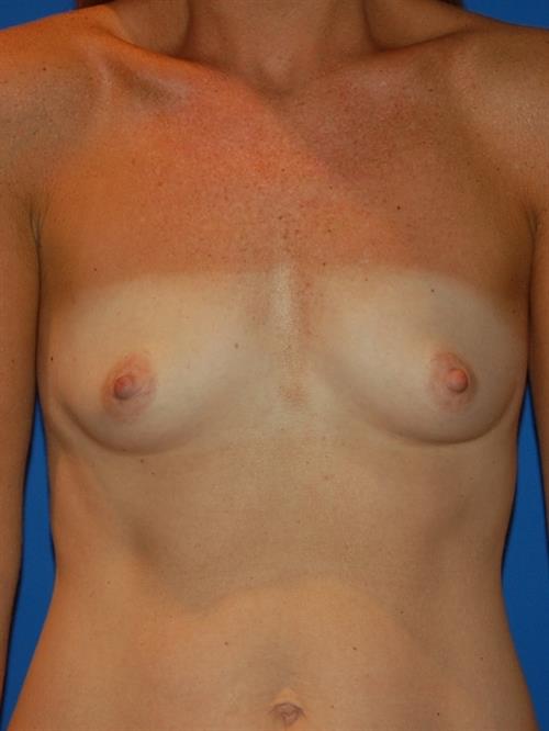 Breast Augmentation Before Photo | Phoenix and Scottsdale, AZ | Scottsdale Center for Plastic Surgery