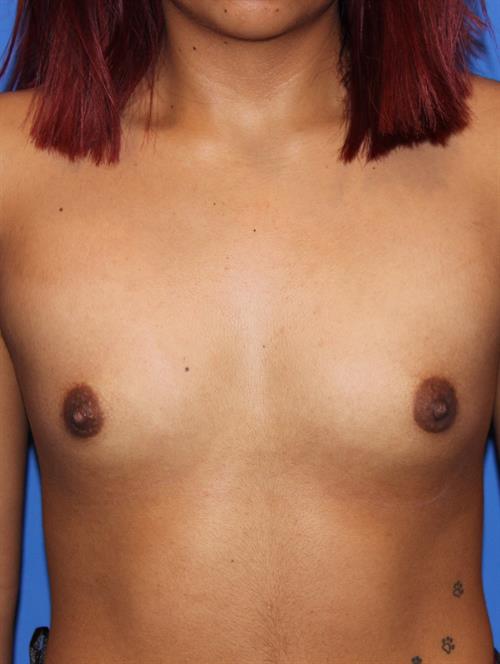 Breast Augmentation Before Photo | Phoenix and Scottsdale, AZ | Scottsdale Center for Plastic Surgery