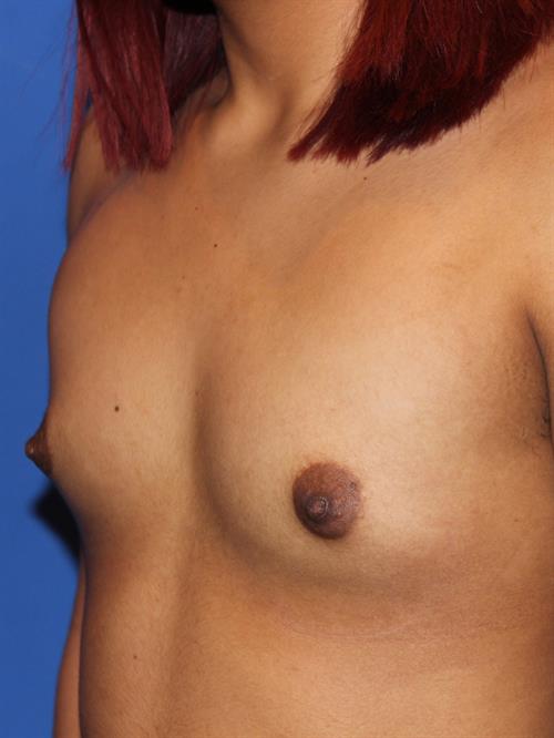 Breast Augmentation Before Photo | Phoenix and Scottsdale, AZ | Scottsdale Center for Plastic Surgery