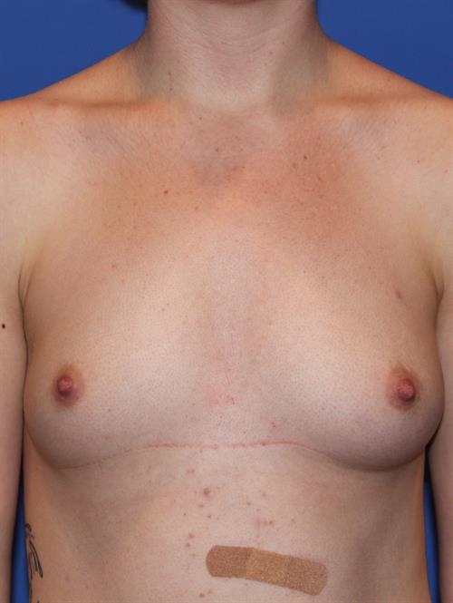 Breast Augmentation Before Photo | Phoenix and Scottsdale, AZ | Scottsdale Center for Plastic Surgery