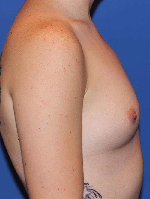 Breast Augmentation Before Photo | Phoenix and Scottsdale, AZ | Scottsdale Center for Plastic Surgery
