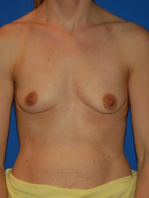 Sub-Fascial Breast Augmentation Before Photo | Phoenix and Scottsdale, AZ | Scottsdale Center for Plastic Surgery