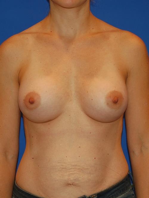 Sub-Fascial Breast Augmentation After Photo | Phoenix and Scottsdale, AZ | Scottsdale Center for Plastic Surgery