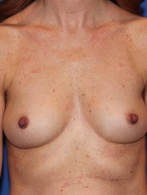 Breast Augmentation Before Photo | Phoenix and Scottsdale, AZ | Scottsdale Center for Plastic Surgery