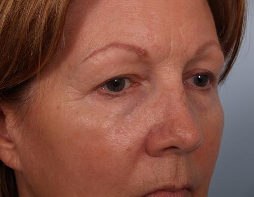 Eyelid Surgery Before Photo | Phoenix and Scottsdale, AZ | Scottsdale Center for Plastic Surgery