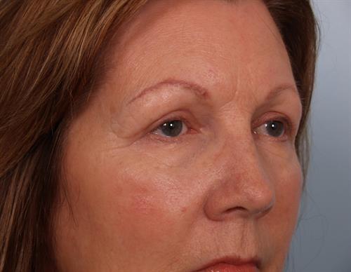 Eyelid Surgery After Photo | Phoenix and Scottsdale, AZ | Scottsdale Center for Plastic Surgery