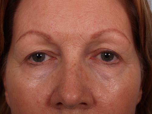 Eyelid Surgery Before Photo | Phoenix and Scottsdale, AZ | Scottsdale Center for Plastic Surgery