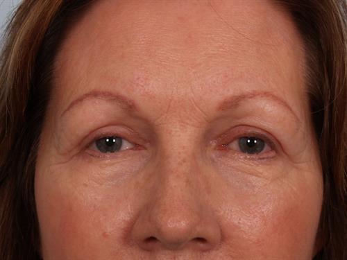 Eyelid Surgery After Photo | Phoenix and Scottsdale, AZ | Scottsdale Center for Plastic Surgery