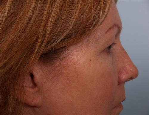 Eyelid Surgery Before Photo | Phoenix and Scottsdale, AZ | Scottsdale Center for Plastic Surgery
