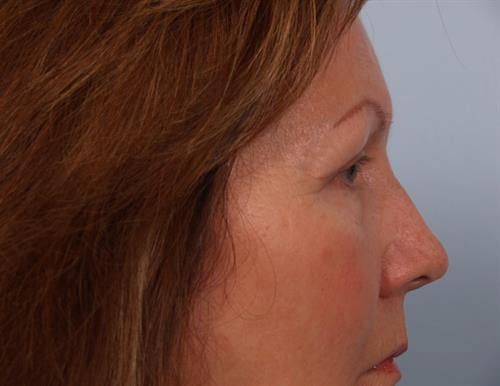 Eyelid Surgery After Photo | Phoenix and Scottsdale, AZ | Scottsdale Center for Plastic Surgery
