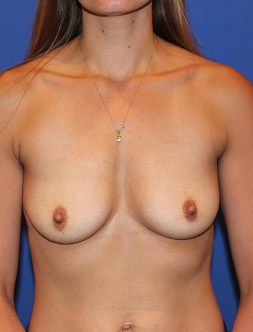 Sub-Fascial Breast Augmentation Before Photo | Phoenix and Scottsdale, AZ | Scottsdale Center for Plastic Surgery