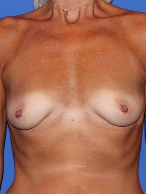 Sub-Fascial Breast Augmentation Before Photo | Phoenix and Scottsdale, AZ | Scottsdale Center for Plastic Surgery