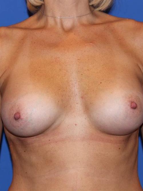 Sub-Fascial Breast Augmentation After Photo | Phoenix and Scottsdale, AZ | Scottsdale Center for Plastic Surgery