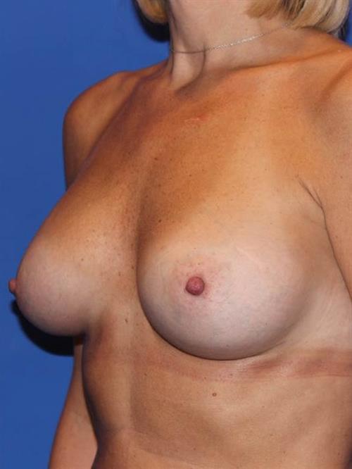 Sub-Fascial Breast Augmentation After Photo | Phoenix and Scottsdale, AZ | Scottsdale Center for Plastic Surgery