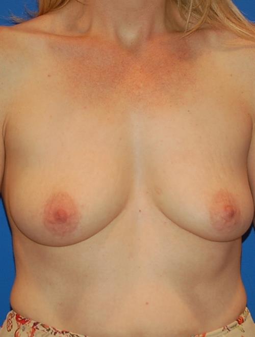 Breast Augmentation Before Photo | Phoenix and Scottsdale, AZ | Scottsdale Center for Plastic Surgery