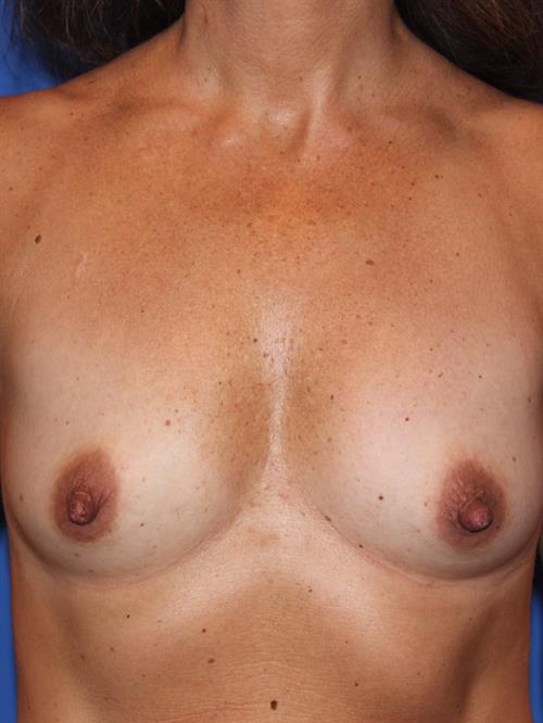 Breast Augmentation Before Photo | Phoenix and Scottsdale, AZ | Scottsdale Center for Plastic Surgery