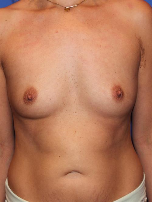 Breast Augmentation Before Photo | Phoenix and Scottsdale, AZ | Scottsdale Center for Plastic Surgery