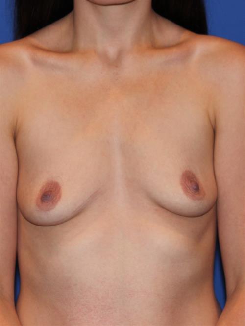 Breast Augmentation Before Photo | Phoenix and Scottsdale, AZ | Scottsdale Center for Plastic Surgery