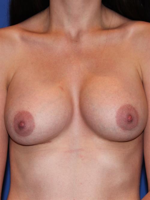 Breast Augmentation After Photo | Phoenix and Scottsdale, AZ | Scottsdale Center for Plastic Surgery
