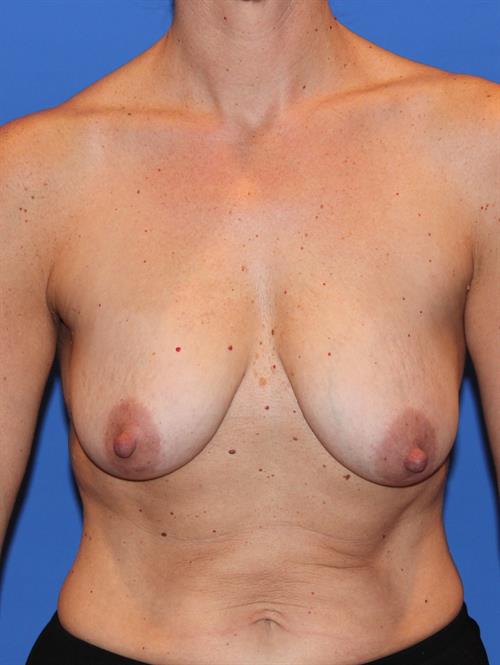 Breast Lift (Mastopexy) Before Photo | Phoenix and Scottsdale, AZ | Scottsdale Center for Plastic Surgery