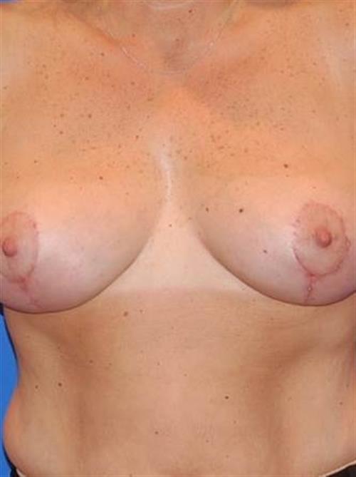 Breast Lift (Mastopexy) After Photo | Phoenix and Scottsdale, AZ | Scottsdale Center for Plastic Surgery