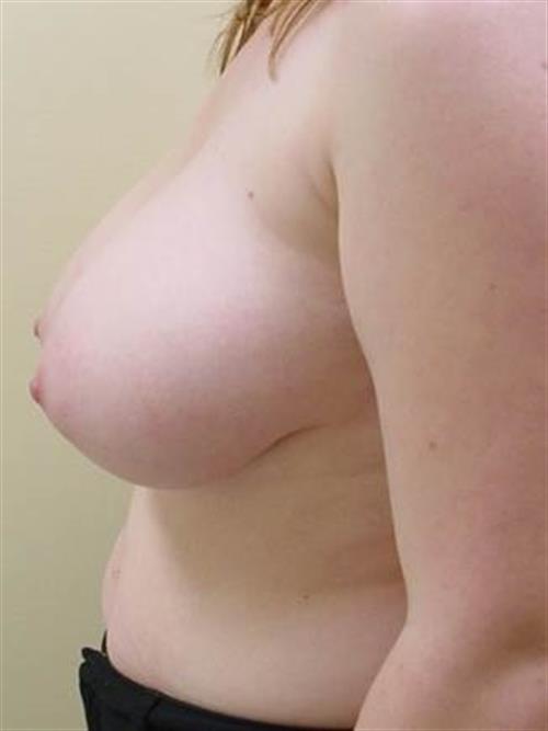 Breast Reduction Before Photo | Phoenix and Scottsdale, AZ | Scottsdale Center for Plastic Surgery