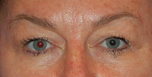 Eyelid Surgery Before Photo | Phoenix and Scottsdale, AZ | Scottsdale Center for Plastic Surgery