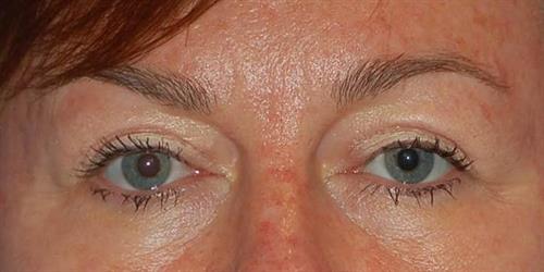 Eyelid Surgery After Photo | Phoenix and Scottsdale, AZ | Scottsdale Center for Plastic Surgery