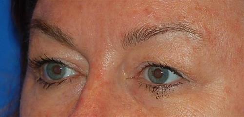 Eyelid Surgery Before Photo | Phoenix and Scottsdale, AZ | Scottsdale Center for Plastic Surgery