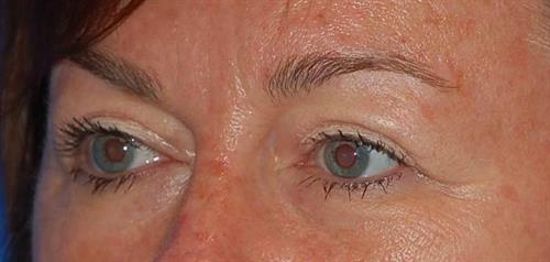 Eyelid Surgery After Photo | Phoenix and Scottsdale, AZ | Scottsdale Center for Plastic Surgery