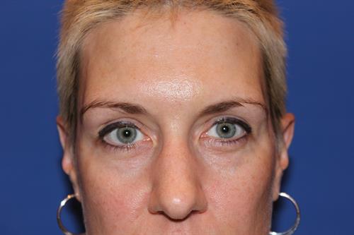 Eyelid Surgery Before Photo | Phoenix and Scottsdale, AZ | Scottsdale Center for Plastic Surgery