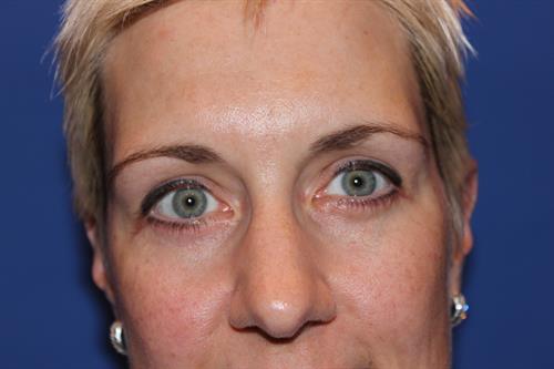 Eyelid Surgery After Photo | Phoenix and Scottsdale, AZ | Scottsdale Center for Plastic Surgery