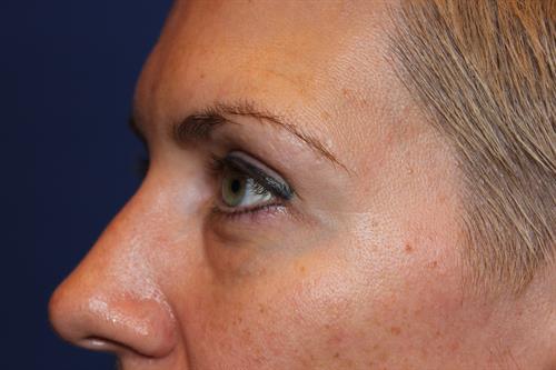 Eyelid Surgery Before Photo | Phoenix and Scottsdale, AZ | Scottsdale Center for Plastic Surgery