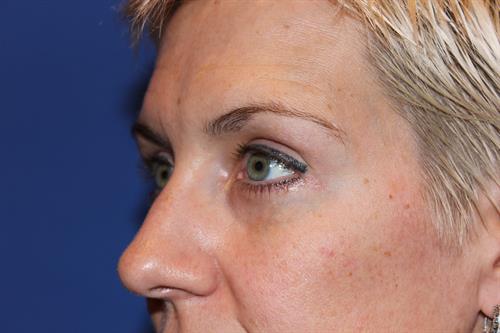 Eyelid Surgery After Photo | Phoenix and Scottsdale, AZ | Scottsdale Center for Plastic Surgery