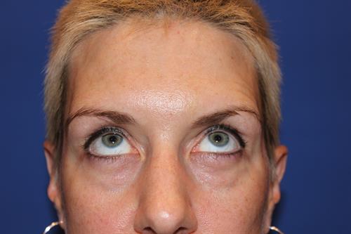 Eyelid Surgery Before Photo | Phoenix and Scottsdale, AZ | Scottsdale Center for Plastic Surgery