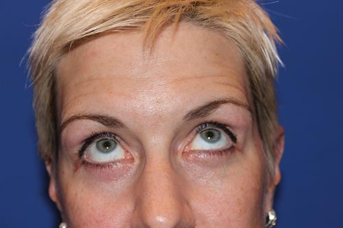 Eyelid Surgery After Photo | ,  | 
