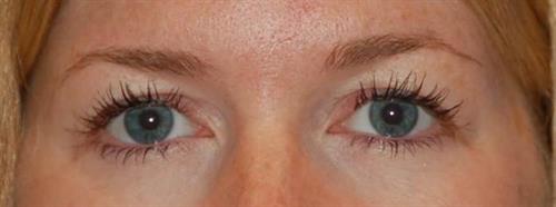 Eyelid Surgery Before Photo | Phoenix and Scottsdale, AZ | Scottsdale Center for Plastic Surgery