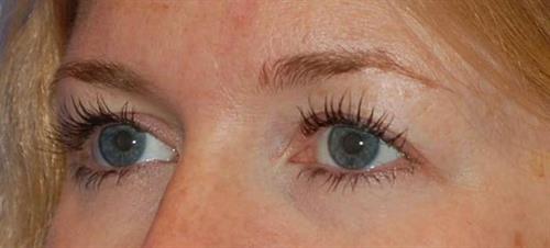 Eyelid Surgery Before Photo | Phoenix and Scottsdale, AZ | Scottsdale Center for Plastic Surgery
