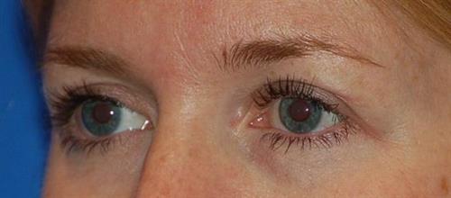 Eyelid Surgery After Photo | Phoenix and Scottsdale, AZ | Scottsdale Center for Plastic Surgery