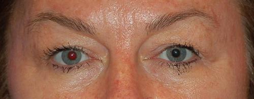 Eyelid Surgery Before Photo | Phoenix and Scottsdale, AZ | Scottsdale Center for Plastic Surgery
