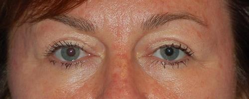 Eyelid Surgery After Photo | Phoenix and Scottsdale, AZ | Scottsdale Center for Plastic Surgery