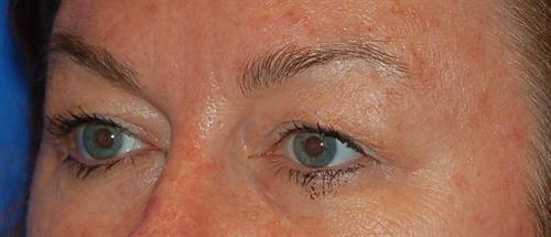 Eyelid Surgery Before Photo | Phoenix and Scottsdale, AZ | Scottsdale Center for Plastic Surgery